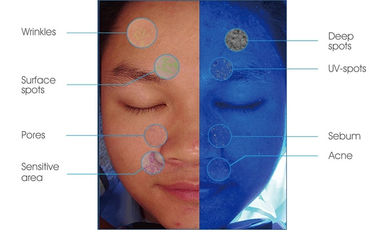 UV-Licht-Haut-Hydratations-Analysator RGB PL für Haut-Problem-Entdeckung